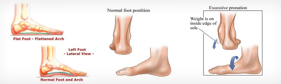 Illustrations comparing a flattened arch with a normal foot arch, and a rear view showing excessive pronation with weight on the inside edge of the sole