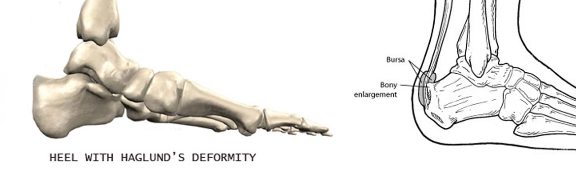 Two illustrations of the heel bone showing Haglund's deformity, with the bony enlargement and the bursa labelled