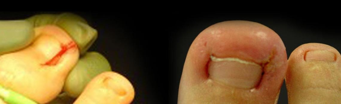 Diagram of a toenail growing into the skin at the nail border