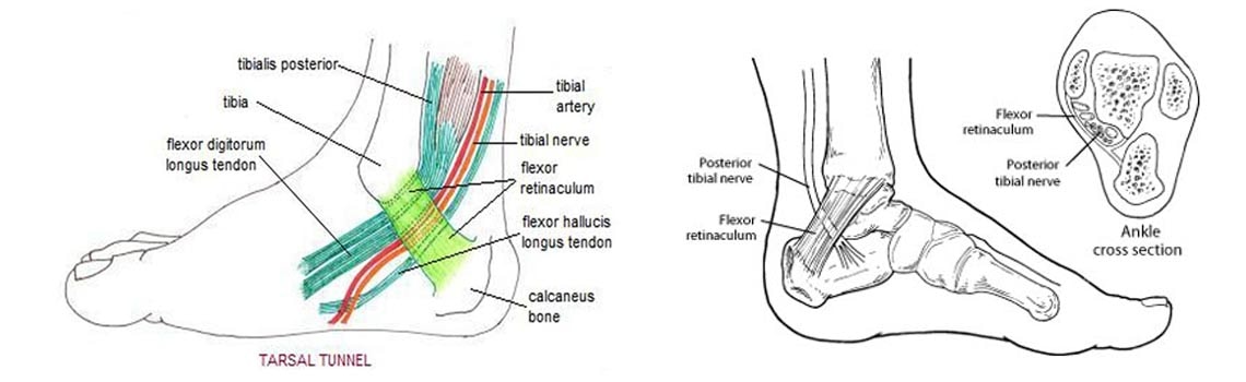 Anatomical illustrations of the inside of the ankle showing the tibial nerve running beneath the flexor retinaculum, with a cross section of the tarsal tunnel